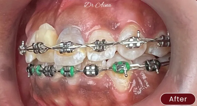 Braces — example 1 after