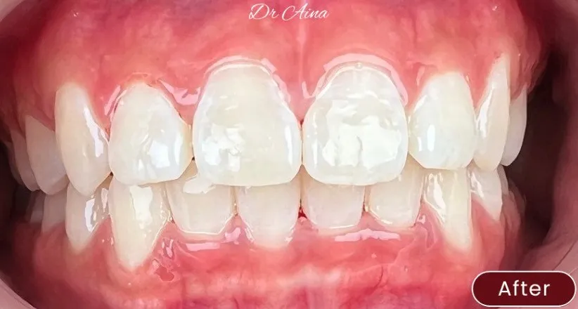 Braces — example 2 after