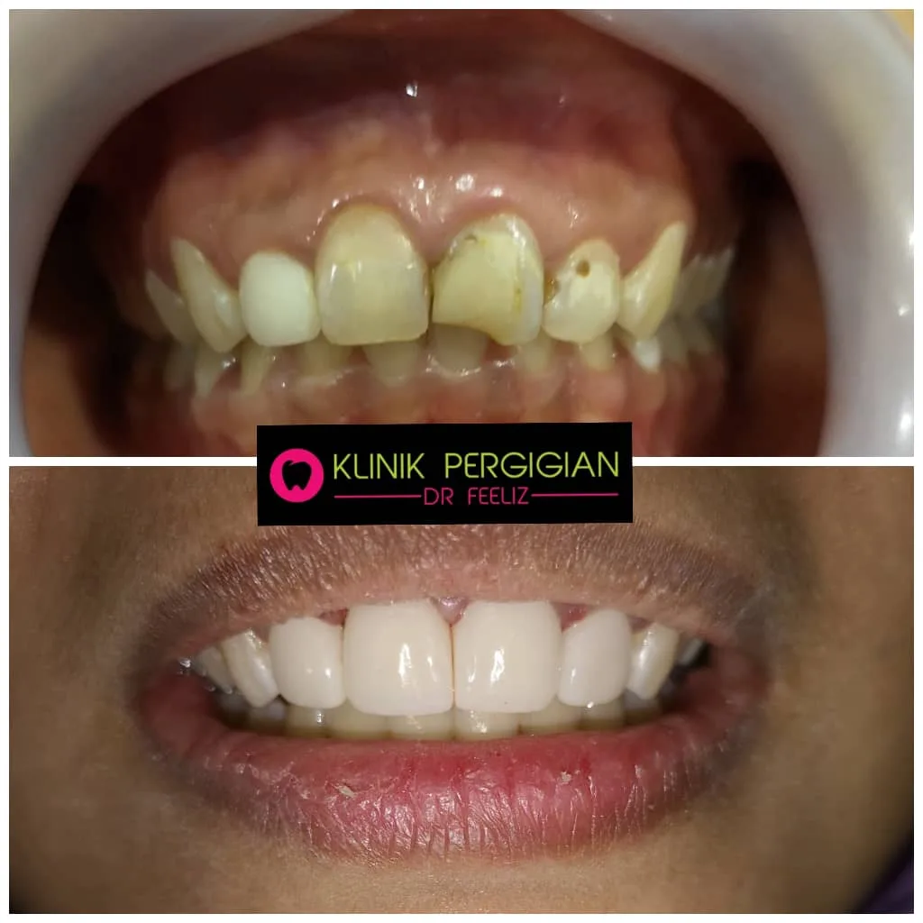 Dental crown and bridge treatment at Dr Feeliz