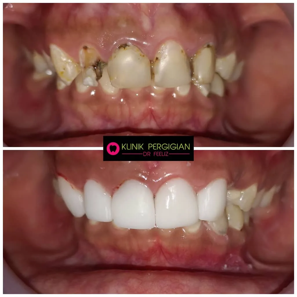 Veneer treatment at Dr Feeliz
