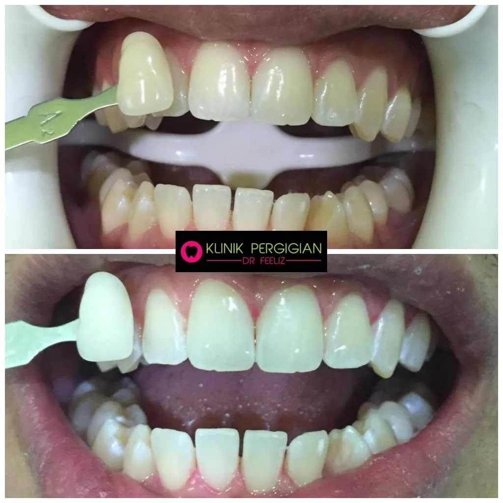 Teeth whitening (pemutihan gigi) at Dr Feeliz